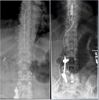 Spinal Cord Stimulation as Treatment for Cancer and Chemotherapy-Induced Pain